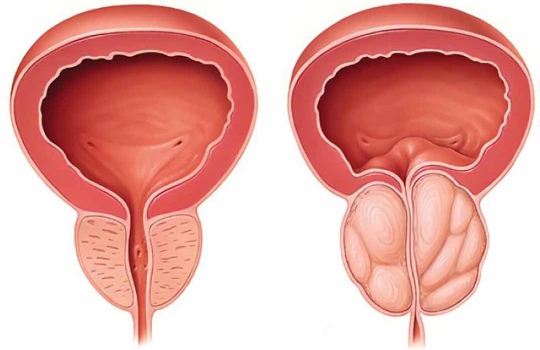 Простата в нормі та запалення передміхурової залози (хронічний простатит)