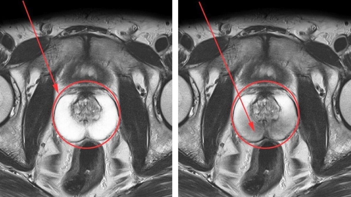 УЗД при хронічному простатиті – здорова простата (ліворуч) та запалена (праворуч)